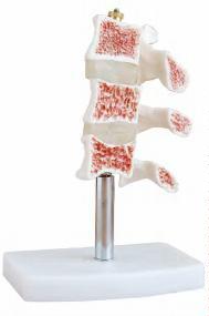صورة مقطع توضيحي لهشاشة العظام (Cutaway Osteoporosis) - واقف للتجارة صنعاء صورة مقطع توضيحي لهشاشة العظام (Cutaway Osteoporosis) - واقف للتجارة صنعاء